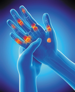 Early Arthritis