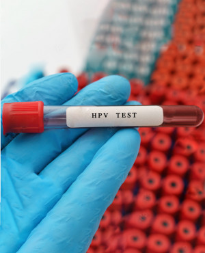 Human Papillomavirus (HPV 16 and HPV 18)